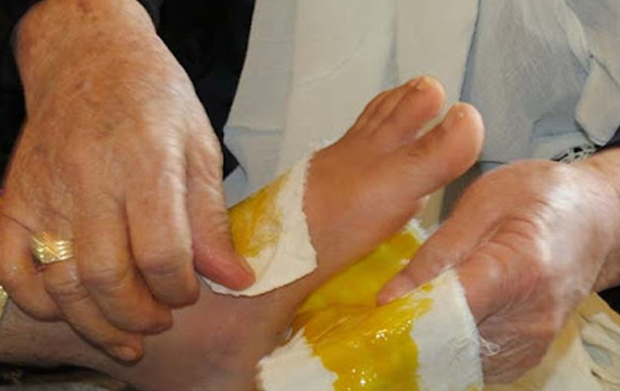 شکسته بندی چیست و چه کاربردی دارد؟